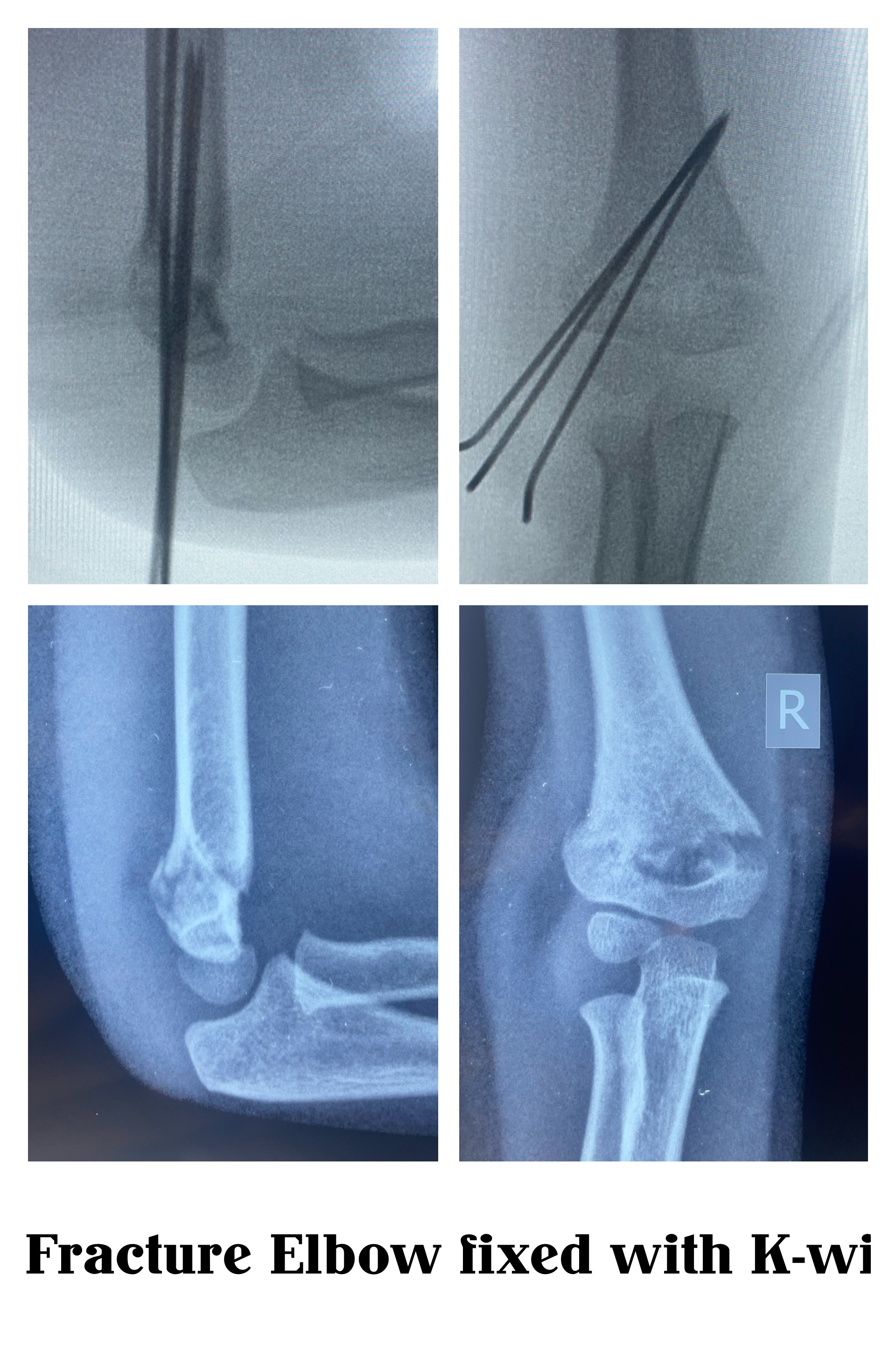 Best Fracture Treatment in Faridabad