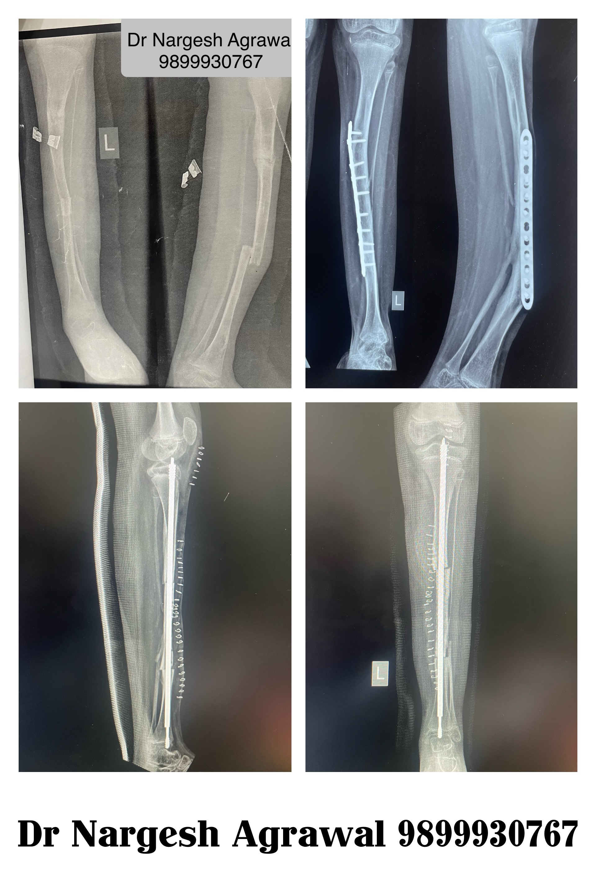 Child Bone Specialist in Faridabad