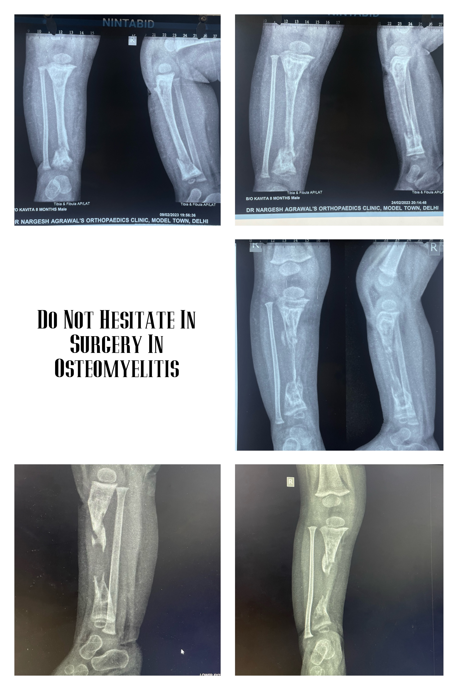 Bone Infection Treatment Doctor in Faridabad
