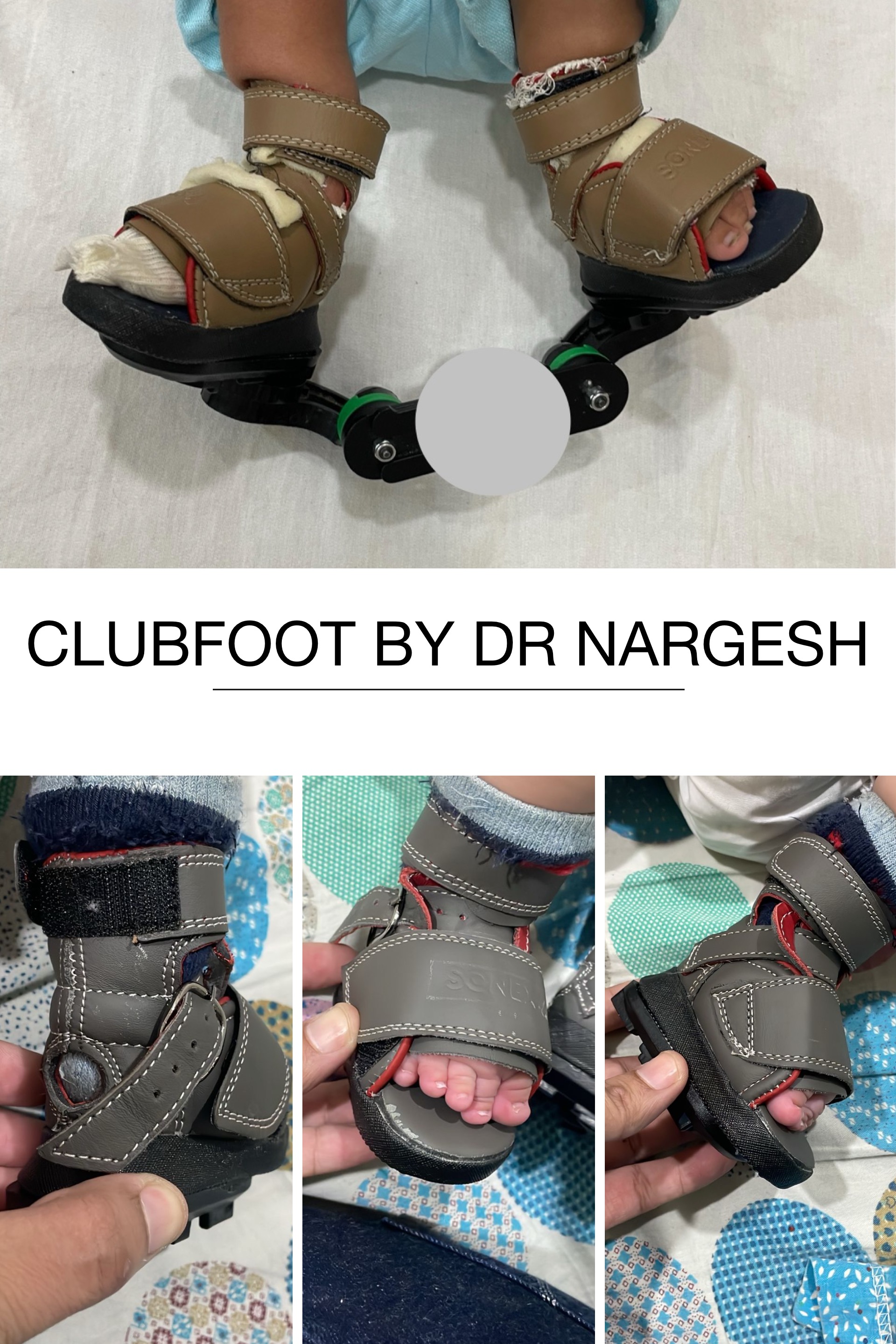 Clubfoot Surgeon in Haryana