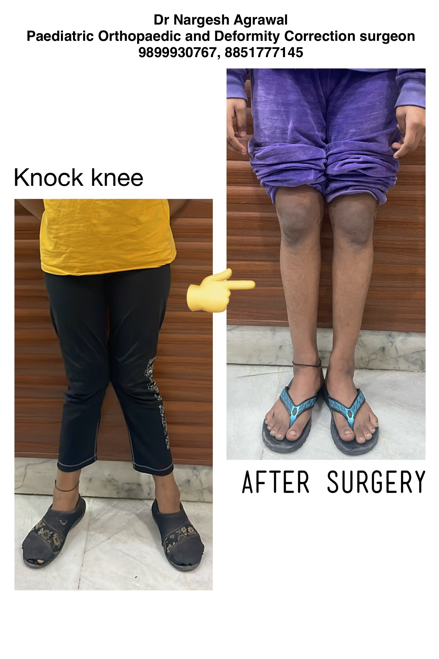 Best Knock Knee Treatment in Haryana